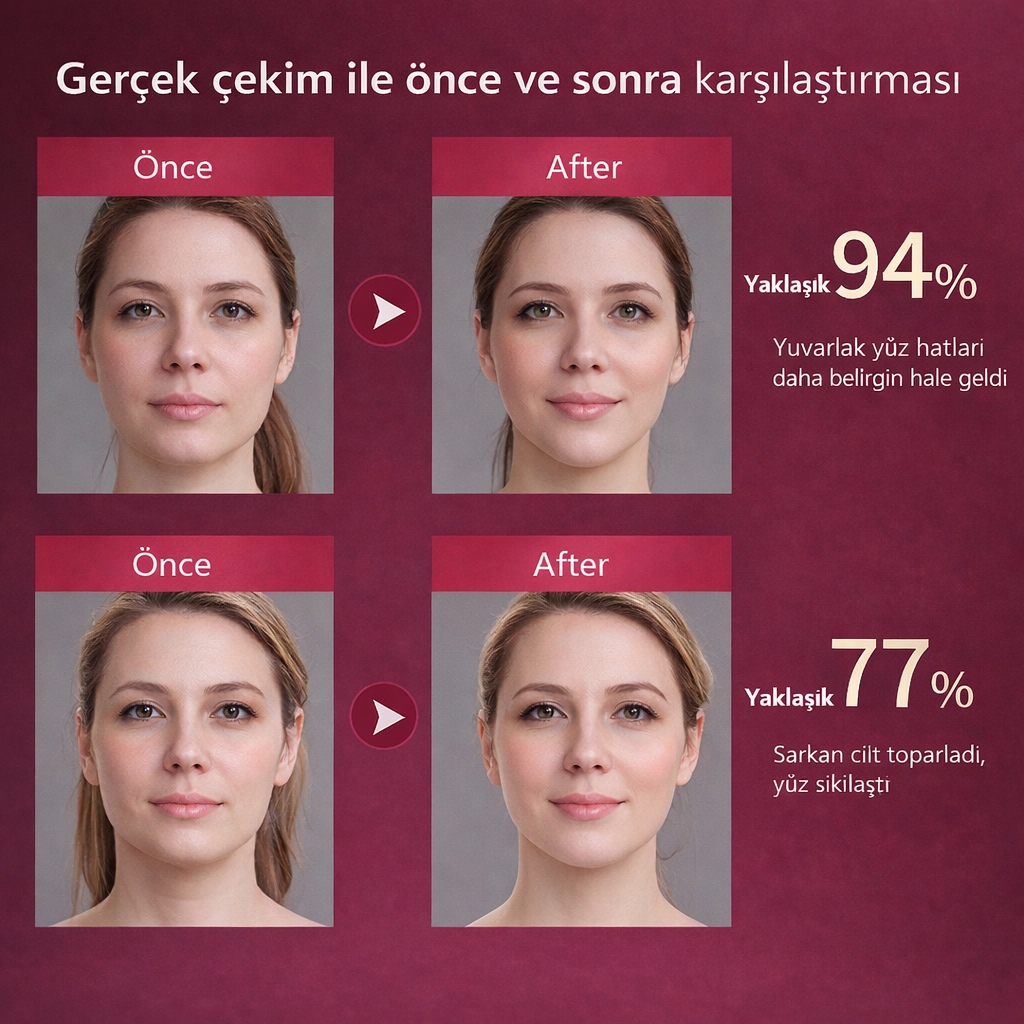 MONICA AURA-V-Face Lift