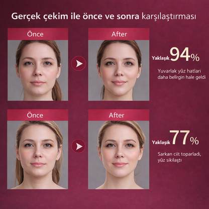 MONICA AURA-V-Face Lift