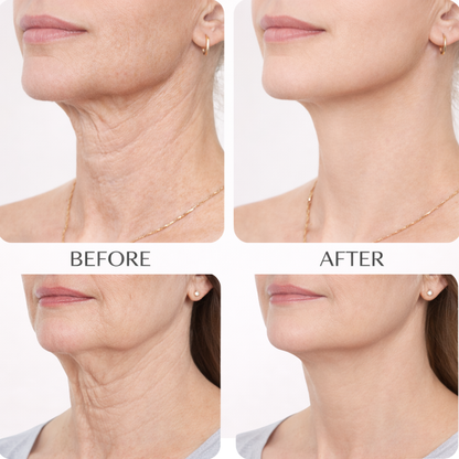 MONICA AURA-LumiLift Pro