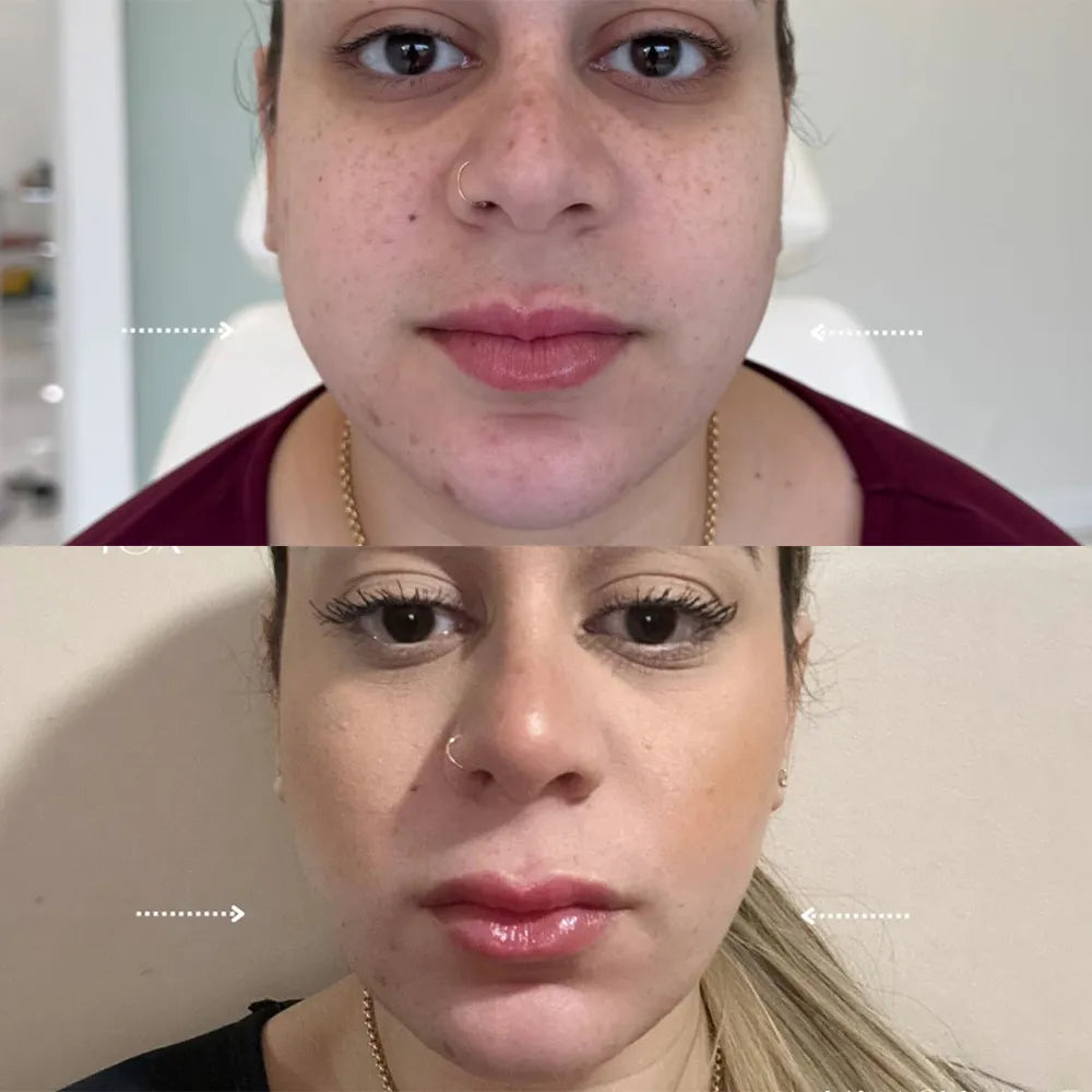 MONICA AURA-LumiLift Pro