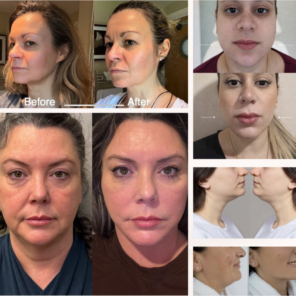 MONICA AURA-LumiLift Pro